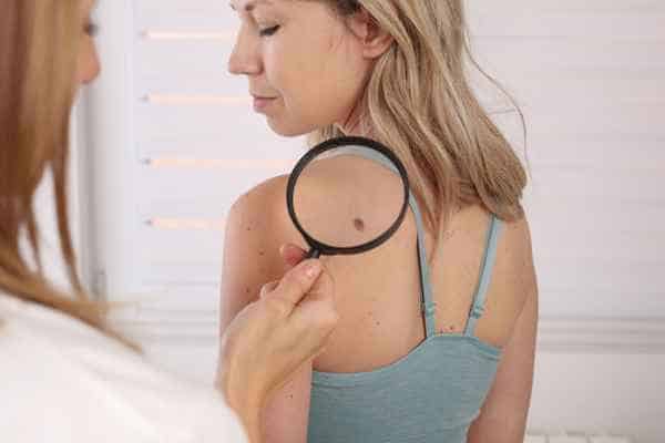 What Are Traditional Skin Lesion Removal Methods Shoreham Beach?