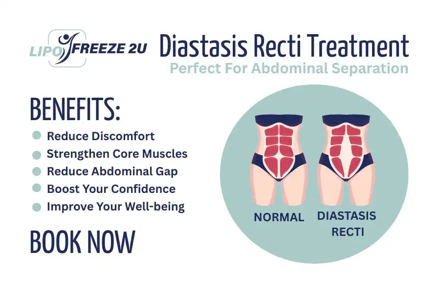 How Long Will It Take to See Improvements in Diastasis Recti Shoreham Beach