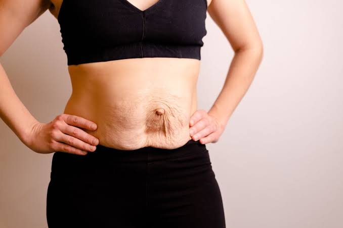 Is Surgery Really the Only Way to Repair Diastasis Recti Shoreham Beach?