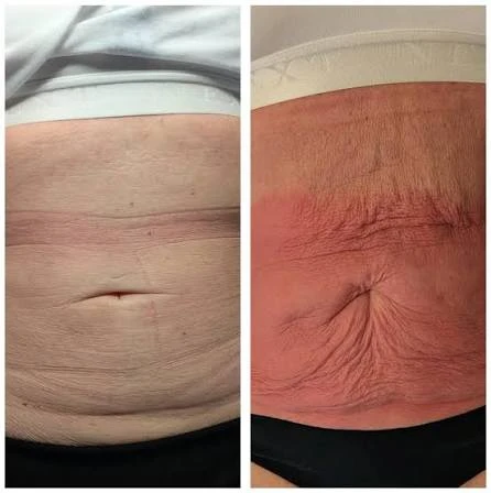 How Does RF Microneedling Improve Crepey, Thin and Uneven Skin Texture Shoreham Beach?