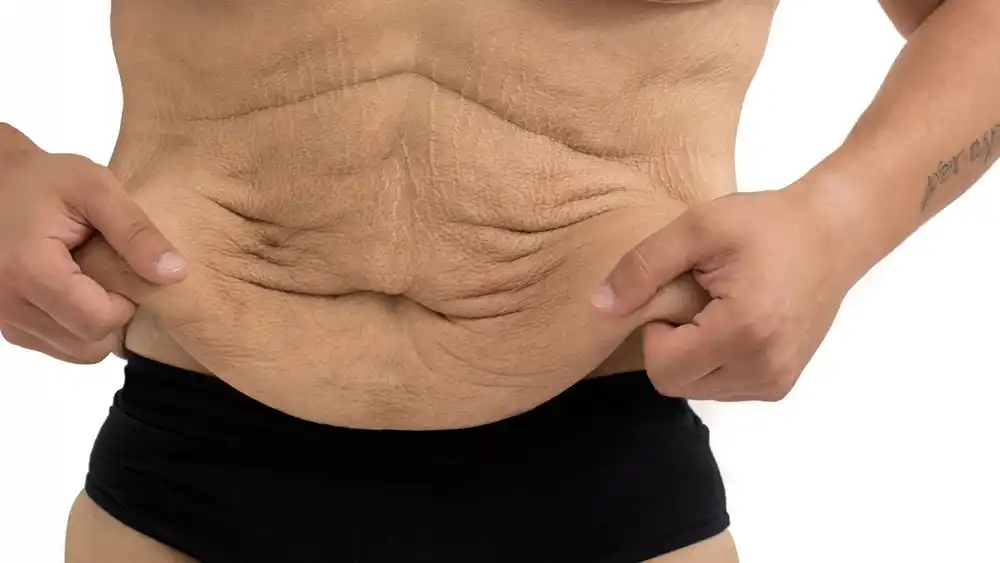 RF Microneedling for Loose Skin: How Can It Help Tighten and Reshape the Skin Shoreham Beach?